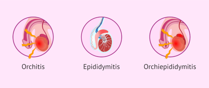 Imagen: Different types of seminal tract infections