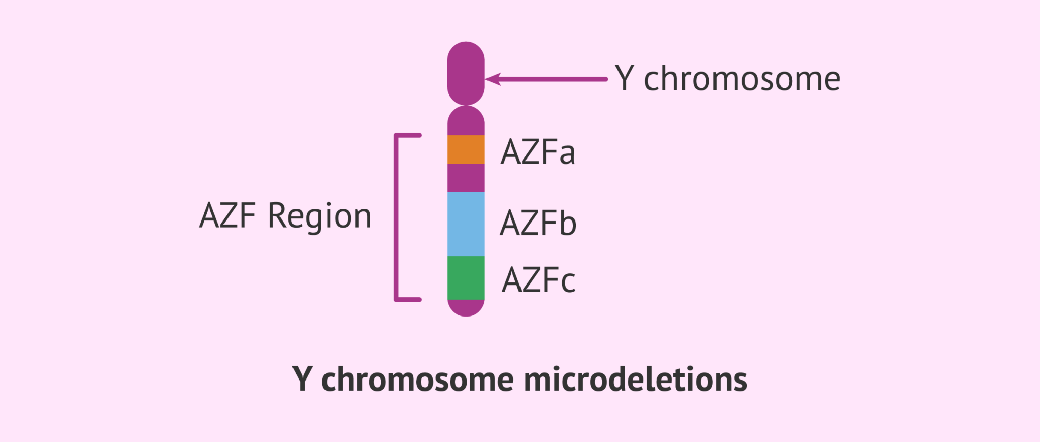 Azoospermia due to microdeletions on the Y-chromosome