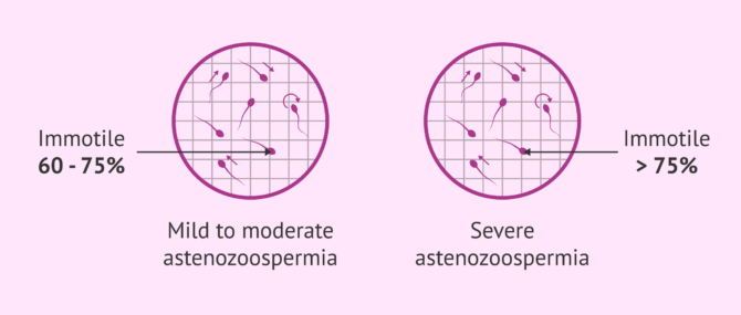Imagen: Types of astenozoospermia
