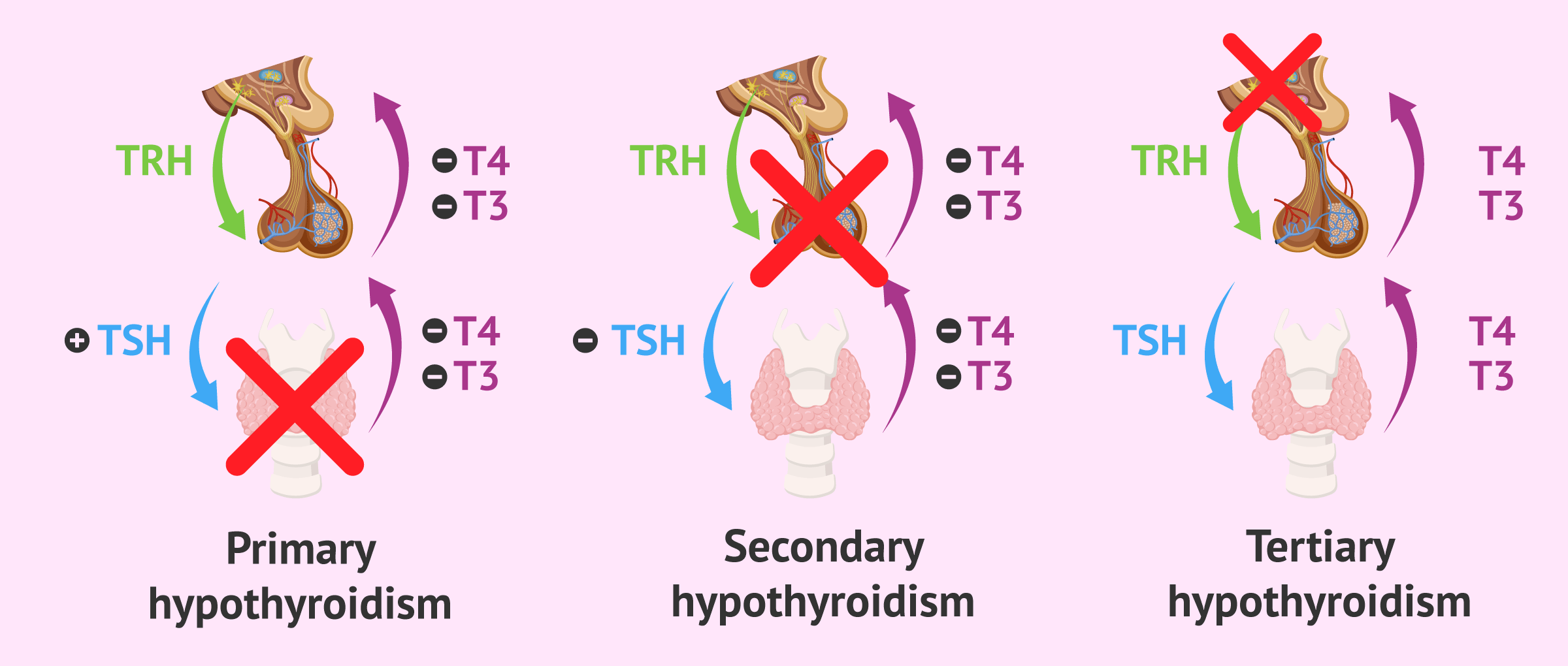 Differences between types of hypothyroidism