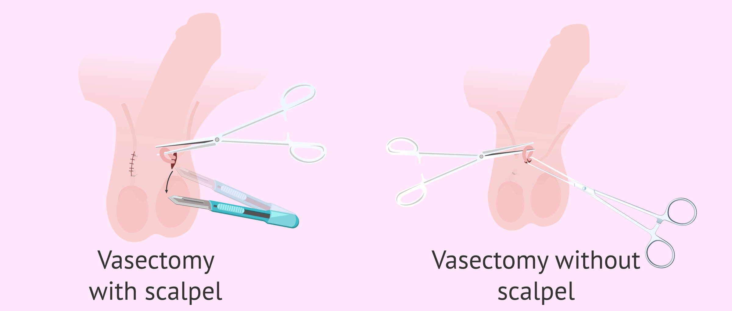 Vasectomy