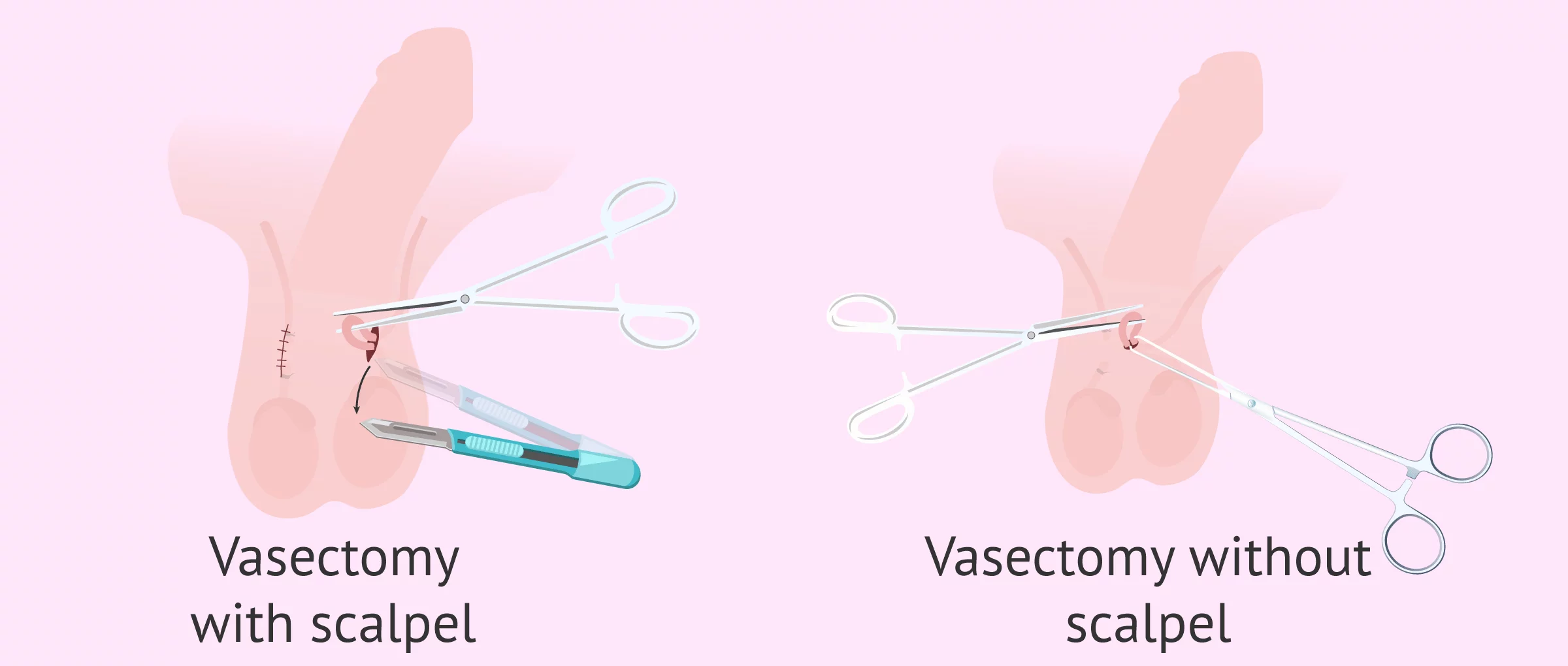 Surgery options for vasectomy