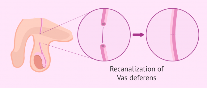 Imagen: Vasosvasostomy: recanalization of the vas deferens