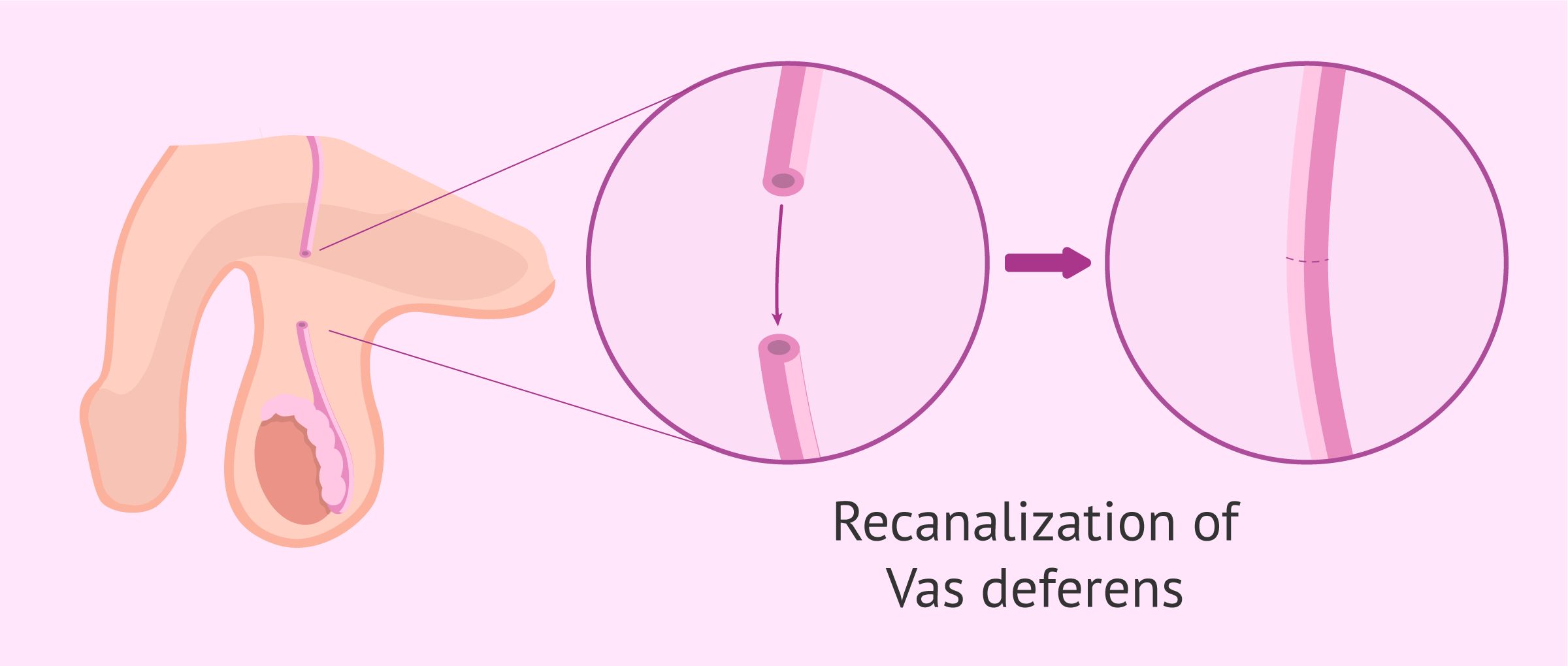 Cuanto cuesta una vasectomia