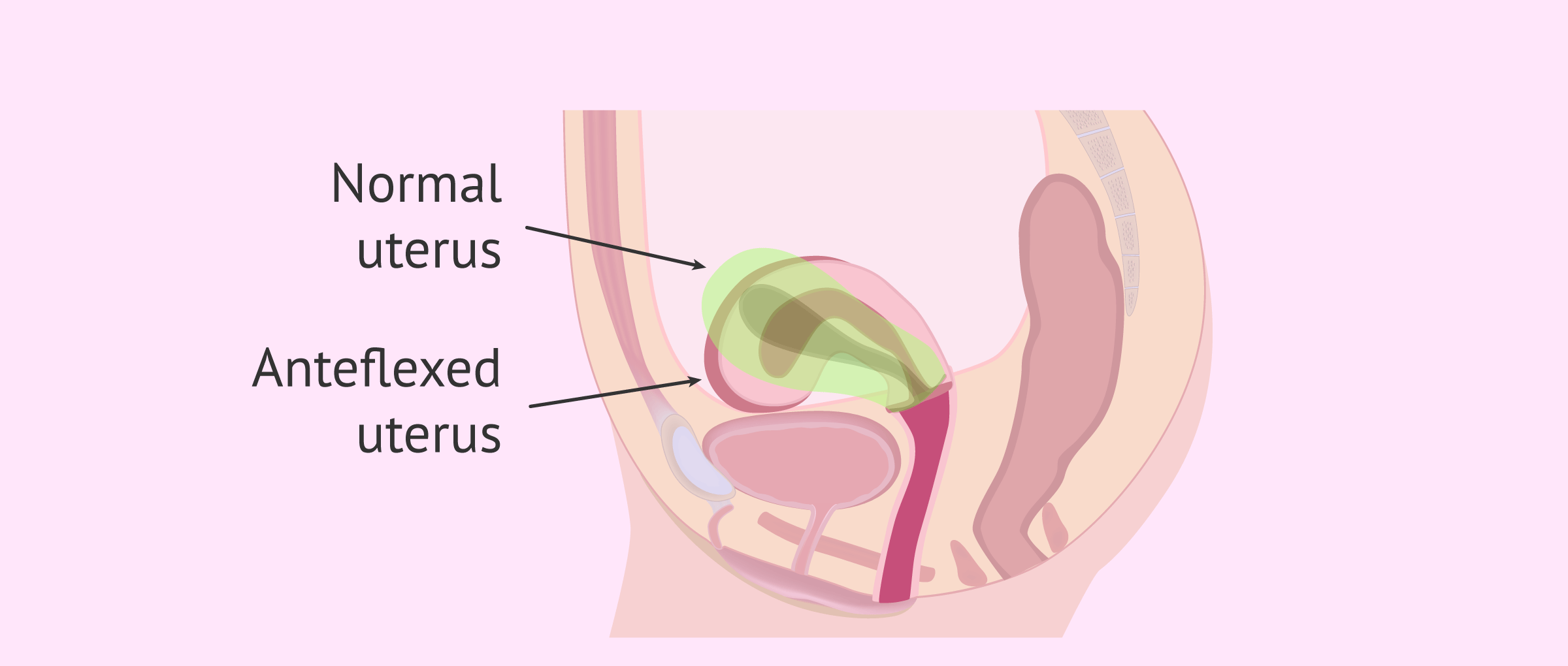Imagen: What does an anteflexed uterus look like?