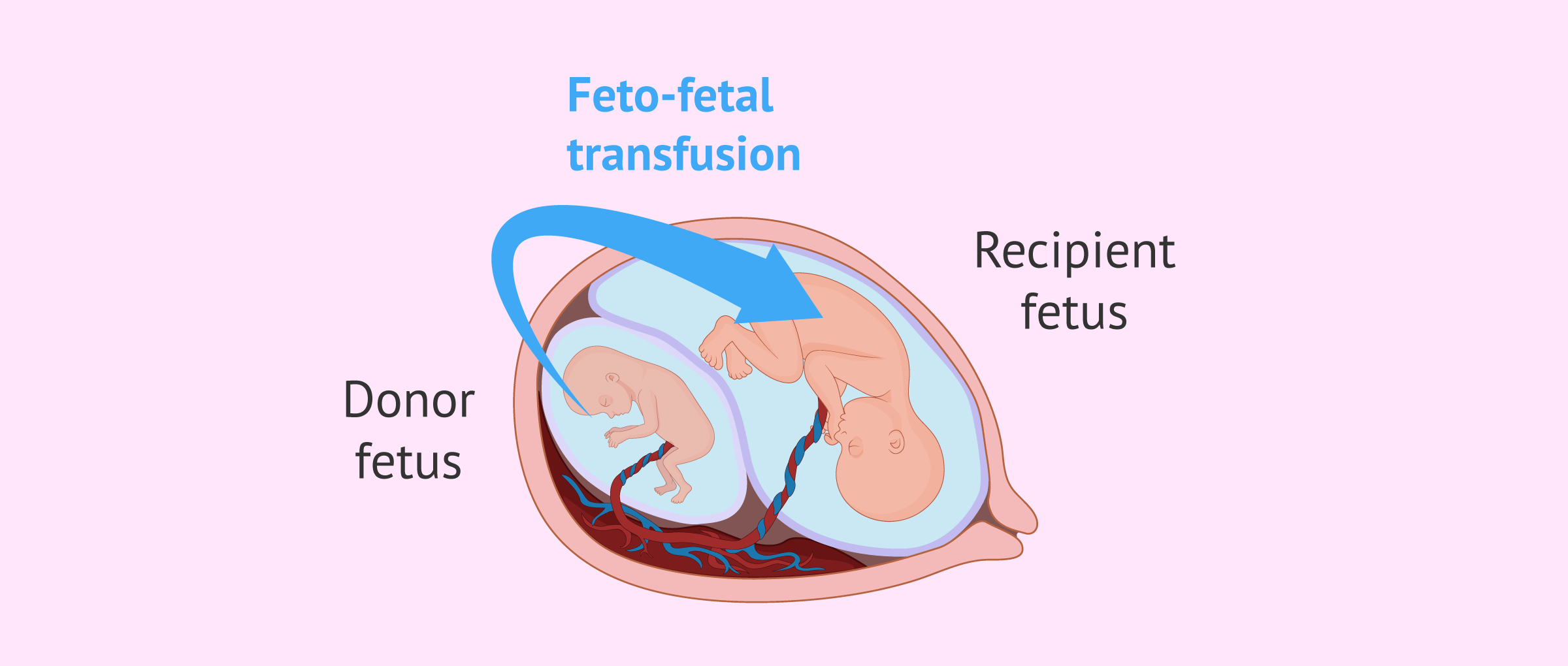 fetal-transfusion-syndrome