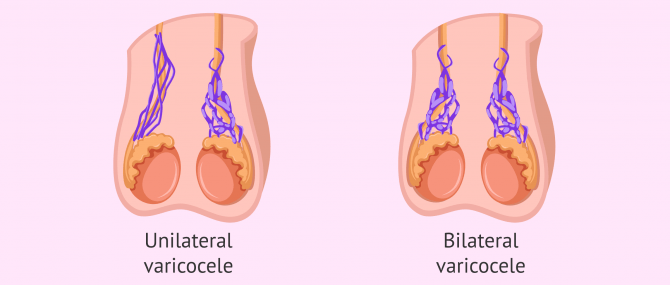 Imagen: Varicocele on one or both sides