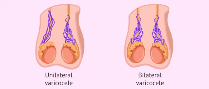 Can pregnancy be achieved with testicular varicocele?