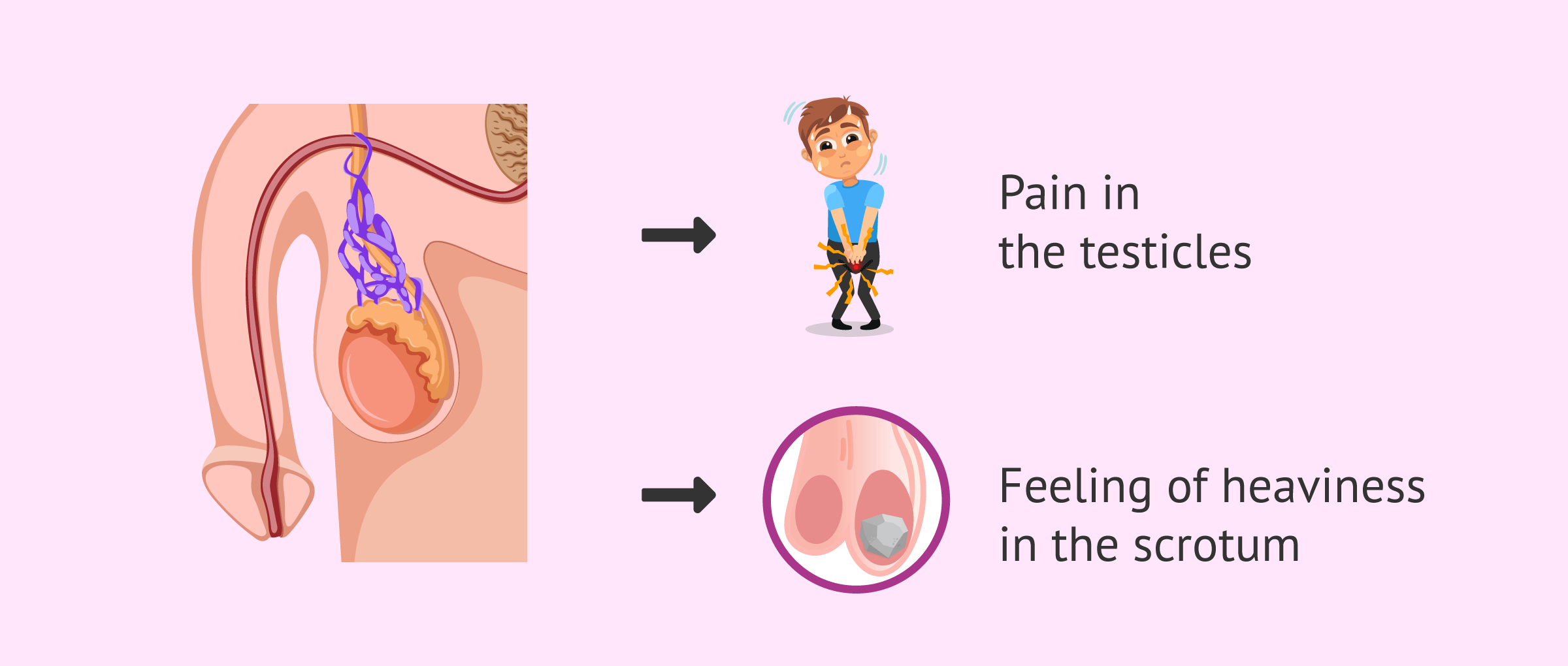 Symptoms of secondary varicocele