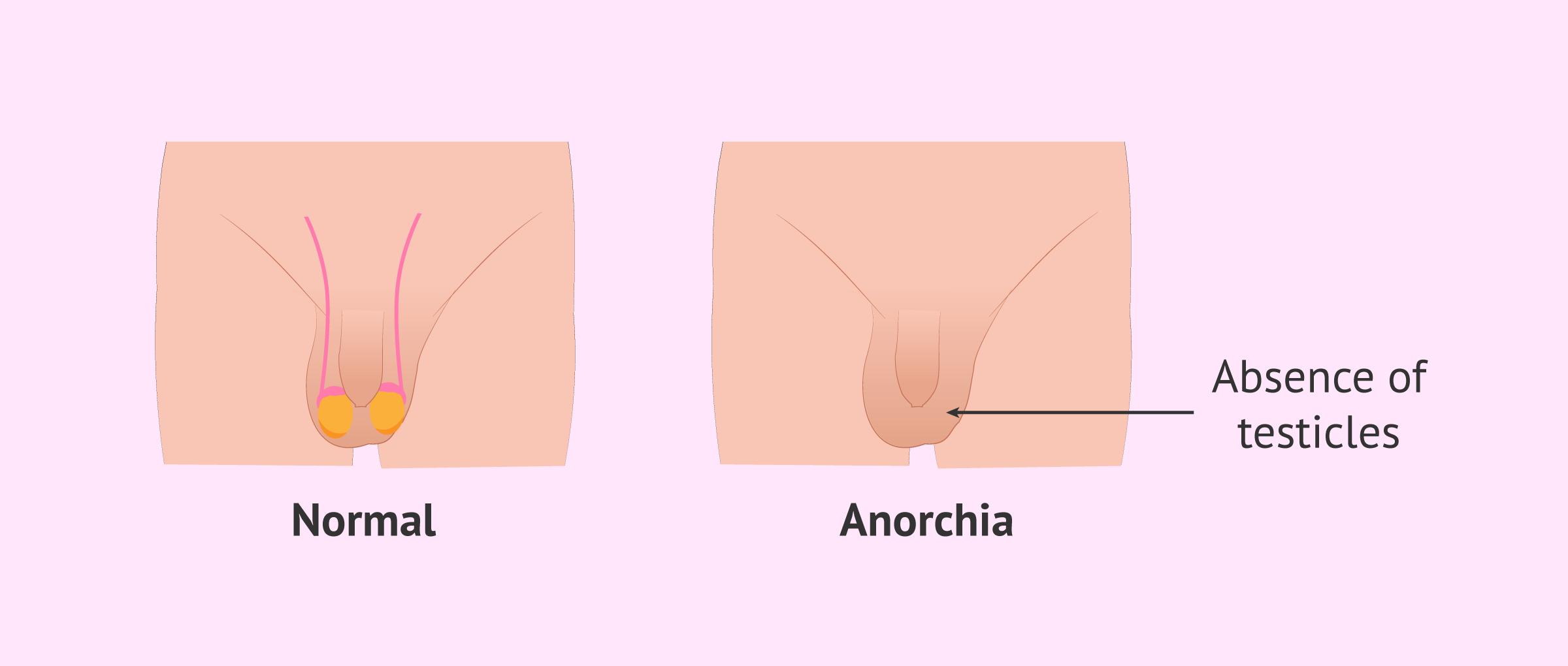 Imagen: anorchia-absence-testicles