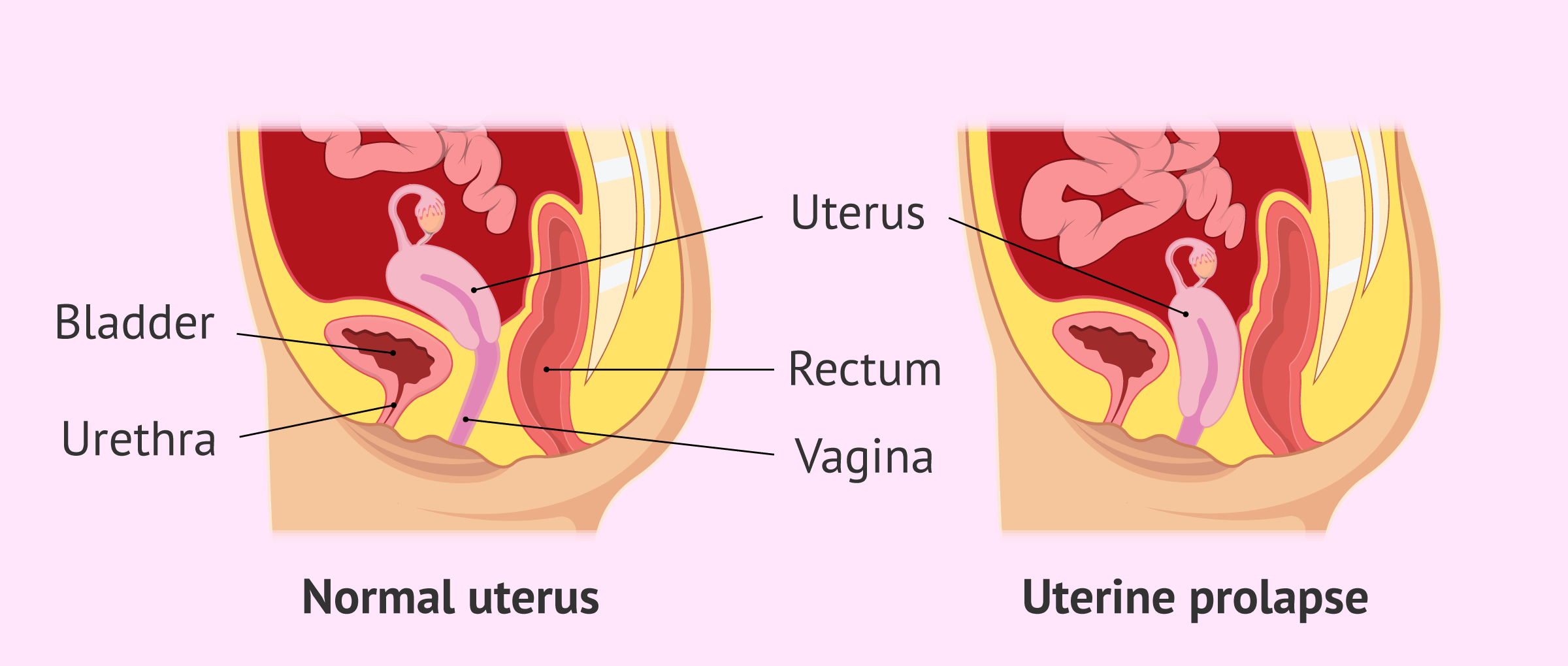 Prolapso vejiga sintomas