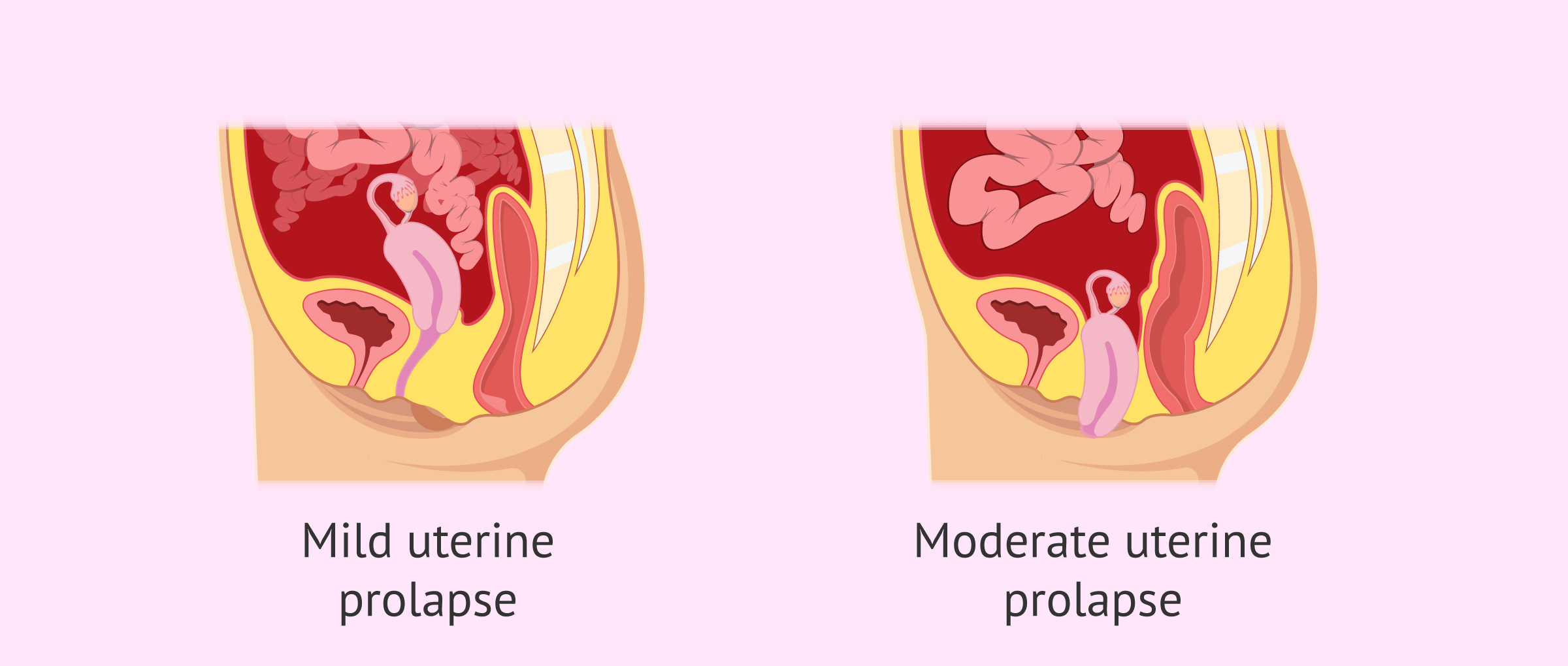 Double Prolapse