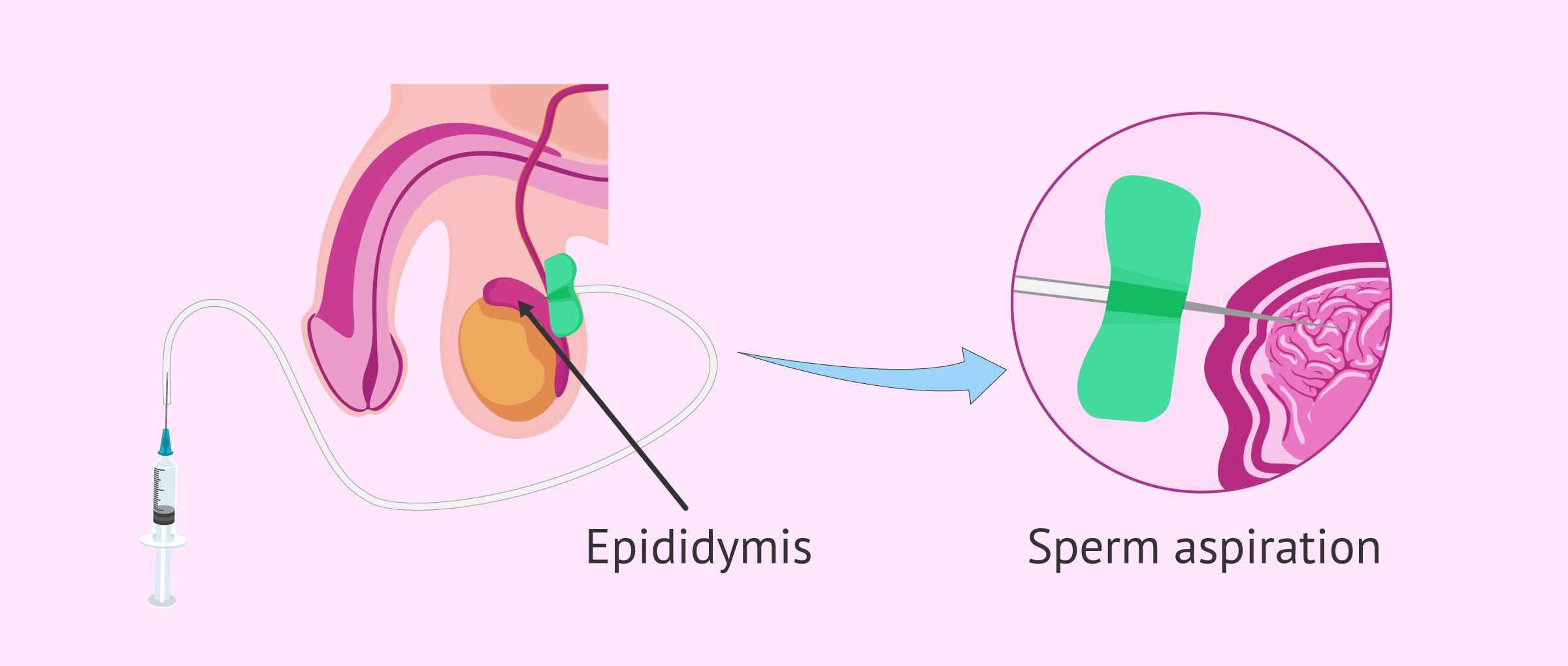 Sperm aspiration from the epididymis by PESA