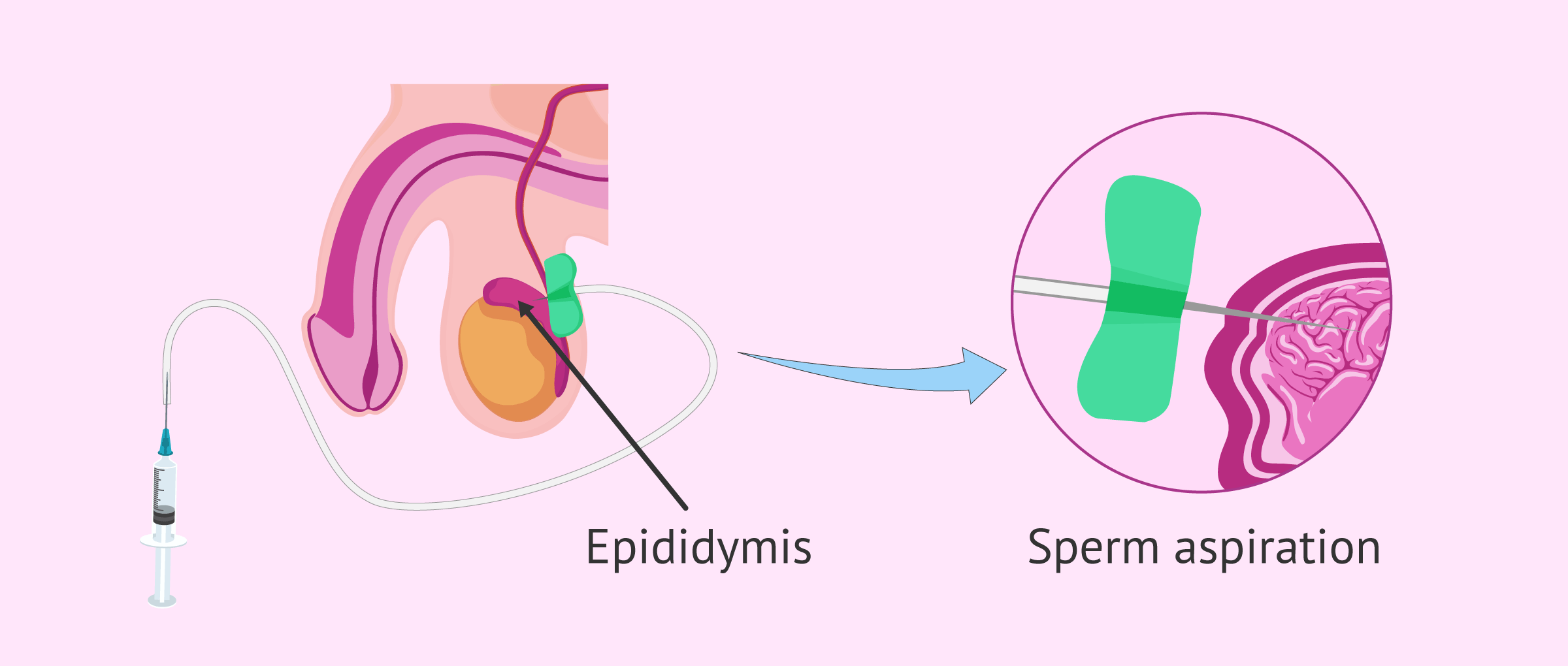 What is Epididymal Sperm Aspiration? Procedure & Techniques