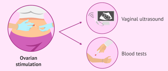 Imagen: Monitoring ovarian stimulation