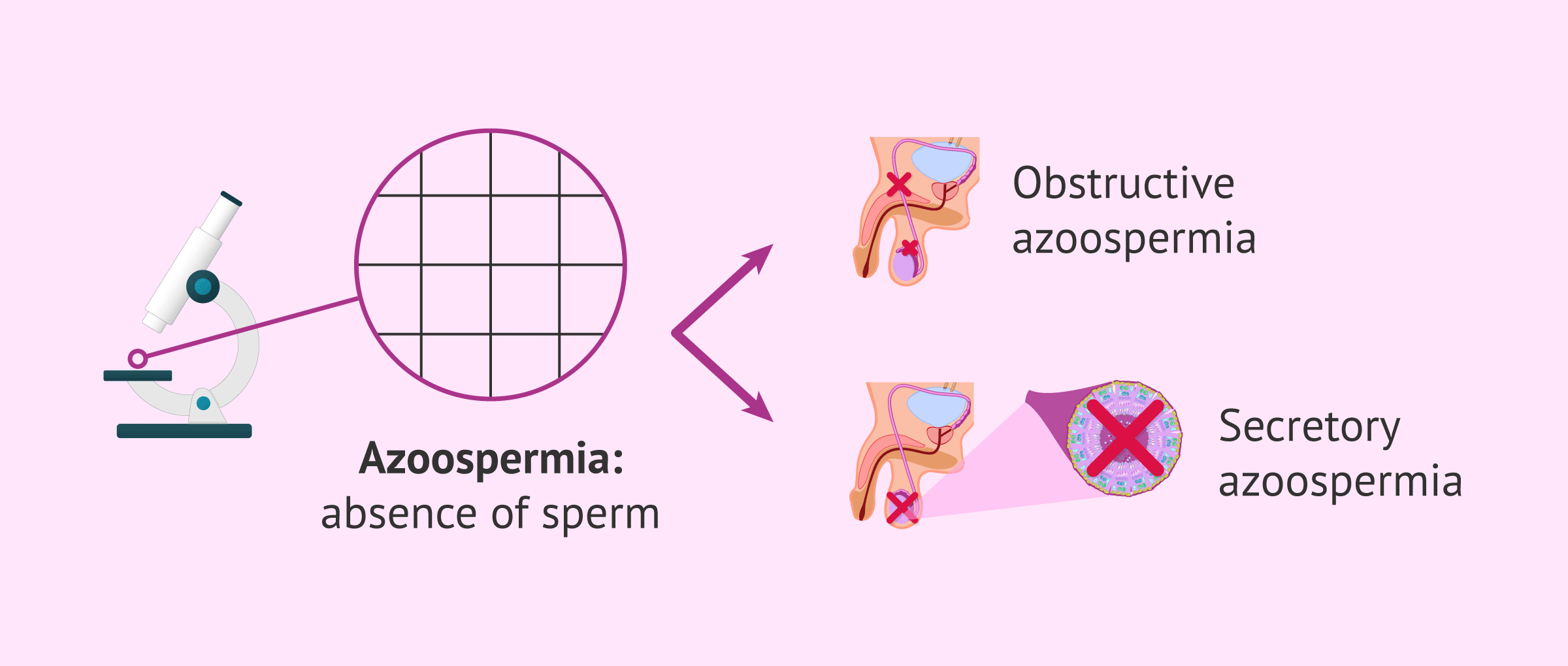Imagen: What does azoospermia look like?