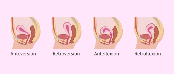 Imagen: Types of uterine positions