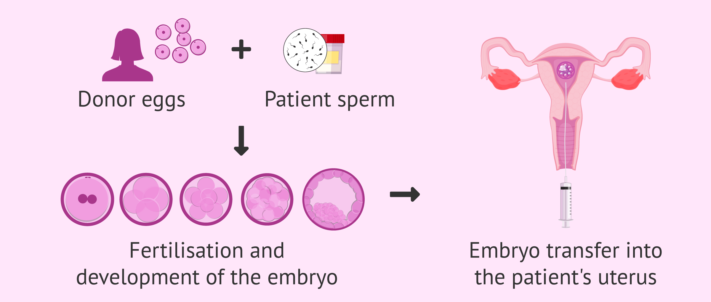 Ovodonation and female infertility