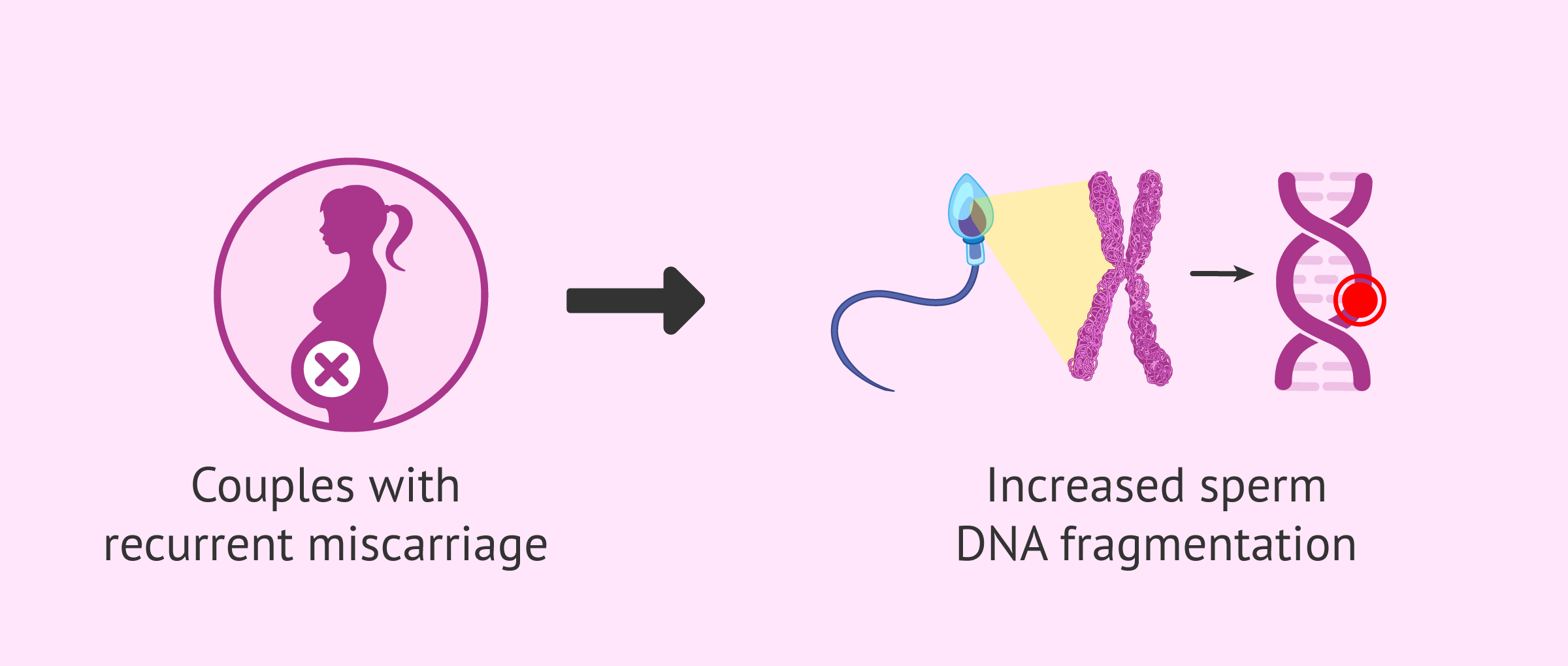 Sperm DNA fragmentation and recurrent miscarriage