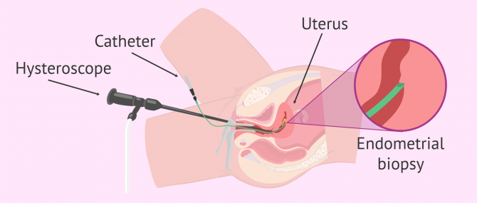 Imagen: How is endometrial scratching done?