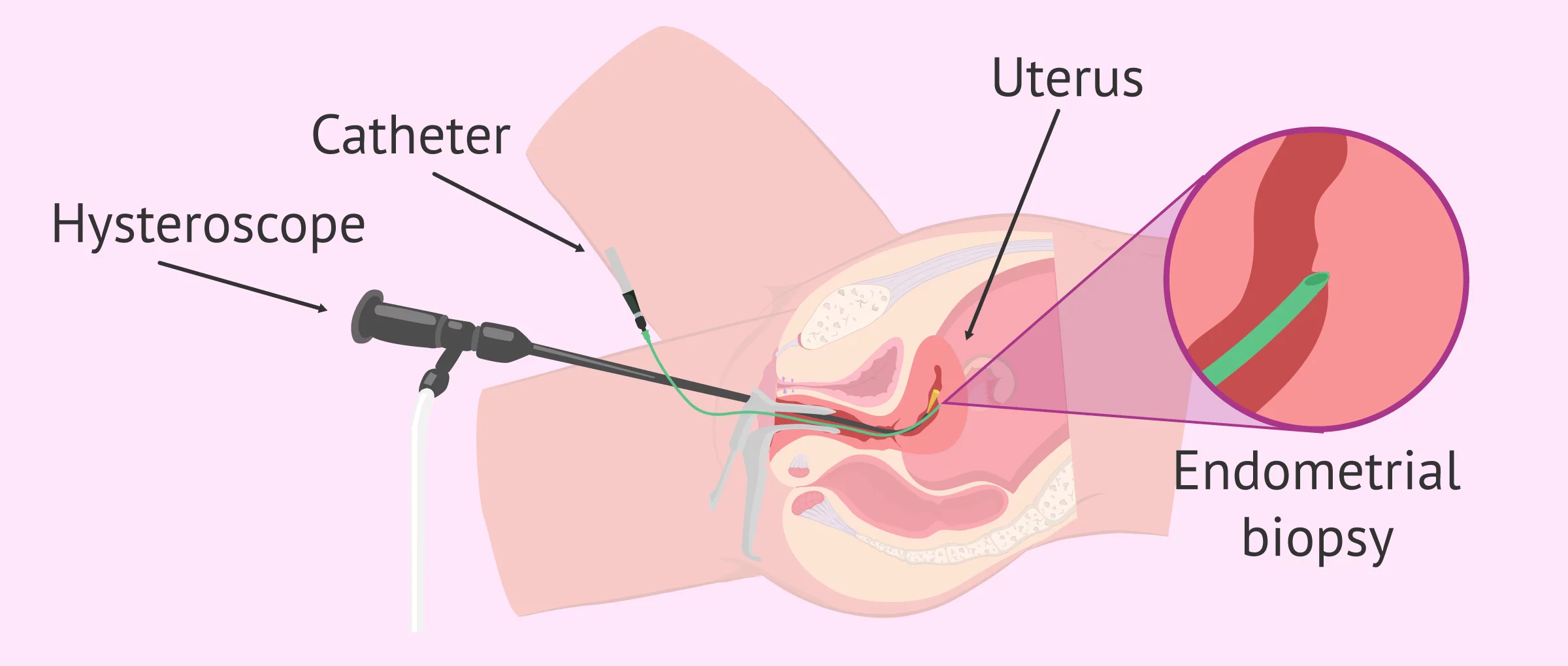 What is endometrial scratching - Indications and procedure