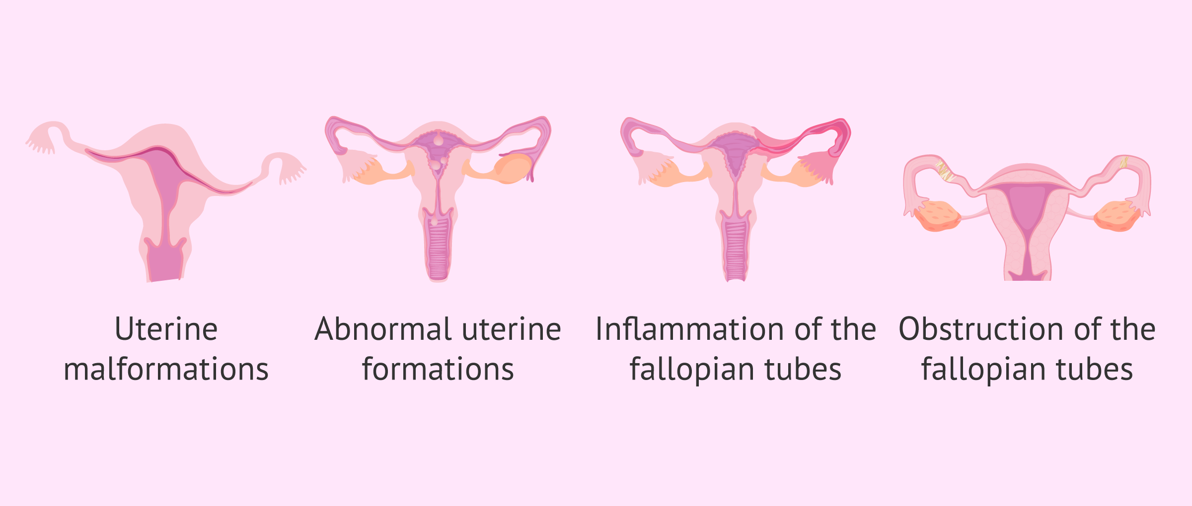 Imagen: Information provided by hysterosalpingography