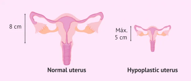 Imagen: The hypoplastic uterus