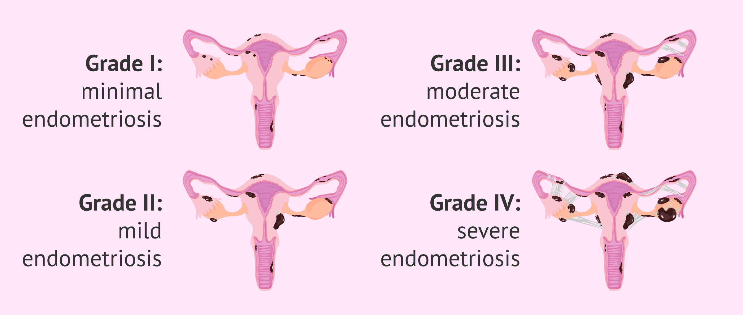 Endometriosis Chart