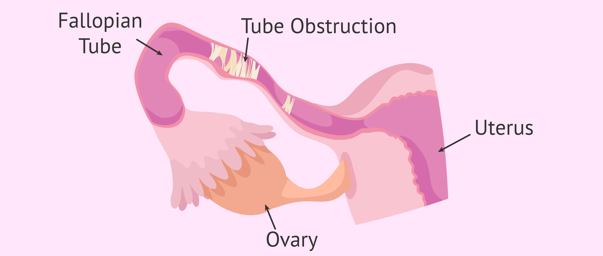 Surgery as a solution to problems in the Fallopian Tubes