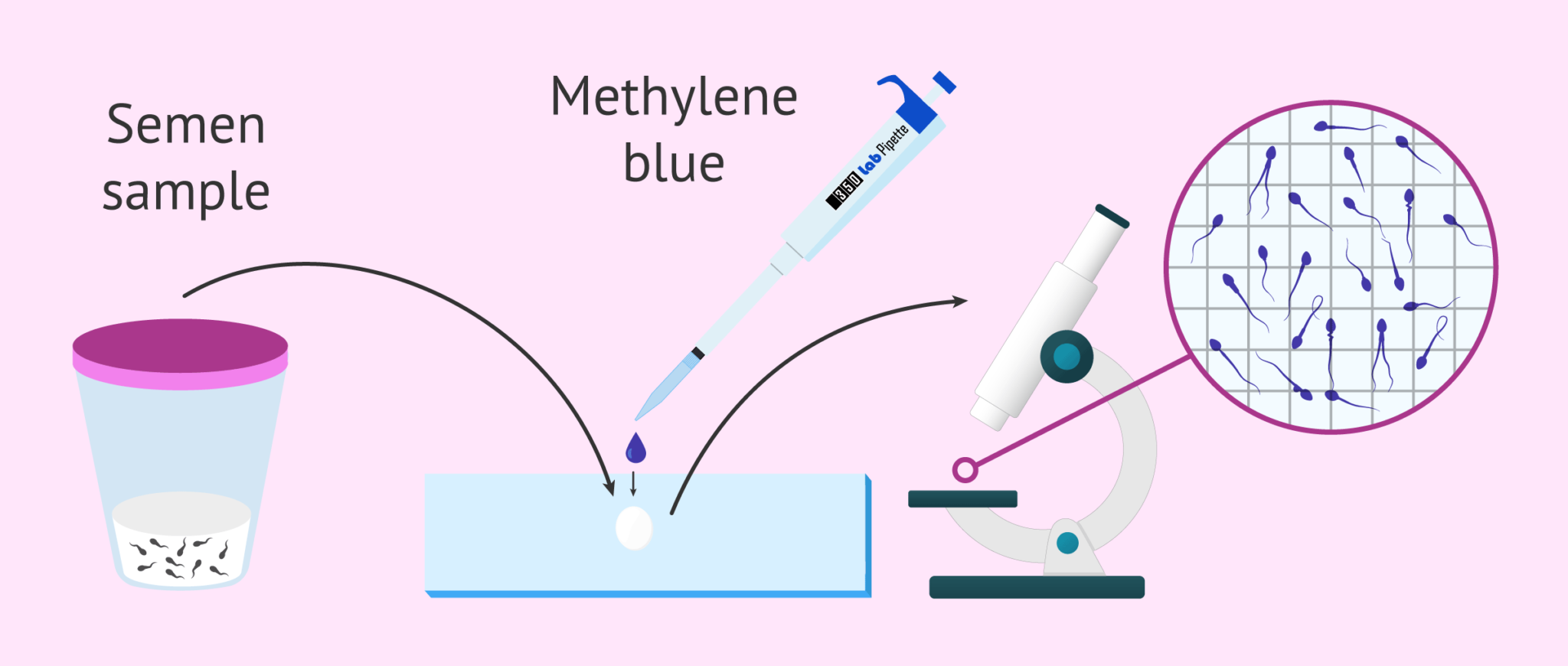 What is teratozoospermia? Its causes, diagnosis and treatment