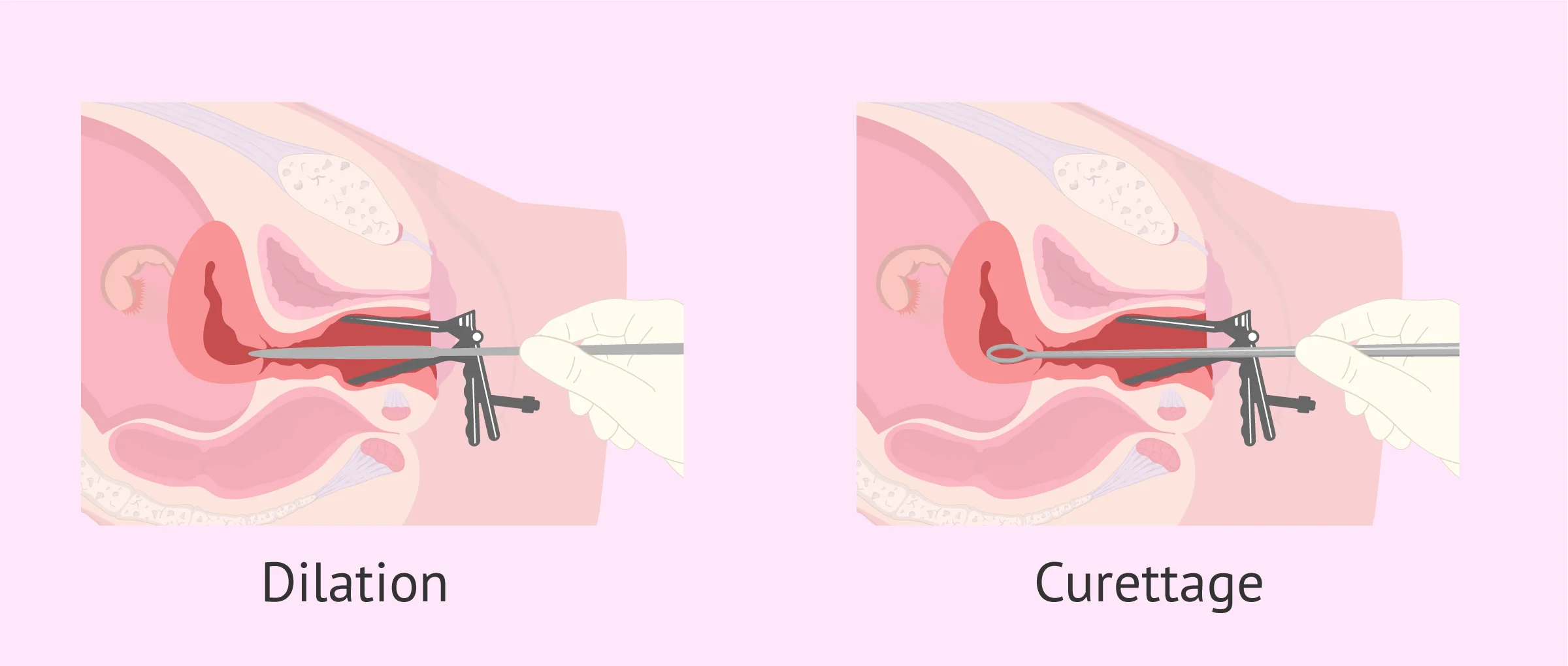 Dilatation and curettage of uterine curettage
