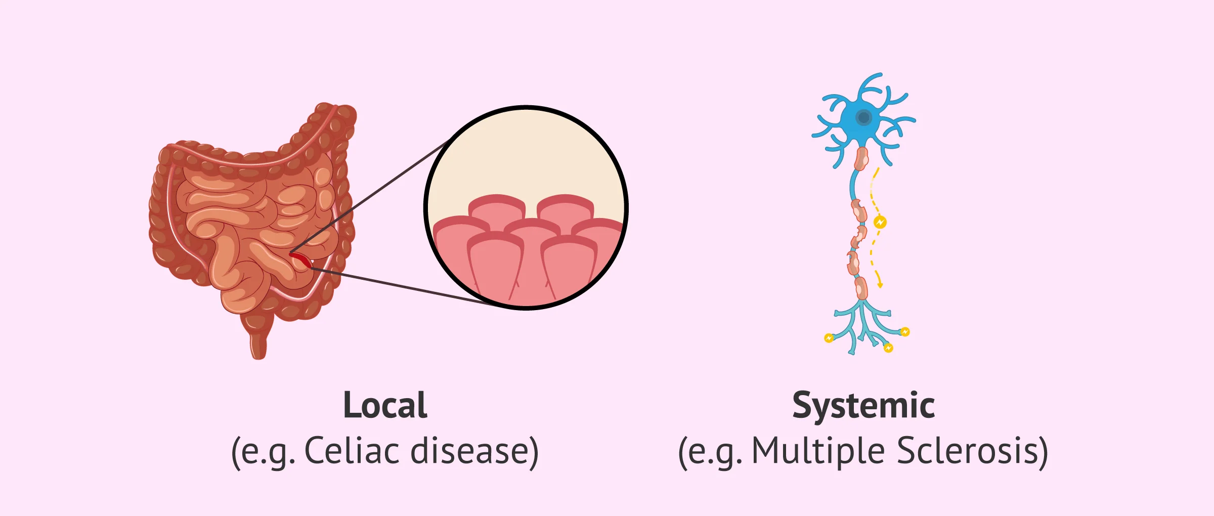 Imagen: Types of autoimmune diseases