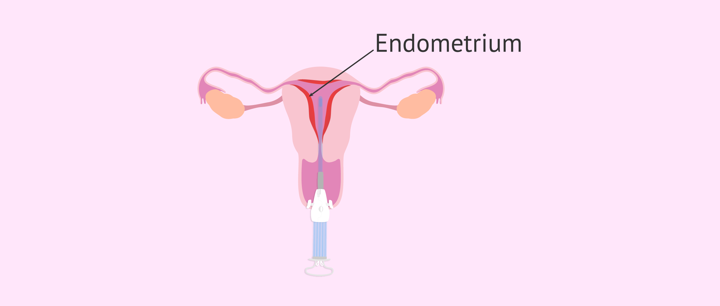 Curettage or scratching of the endometrium