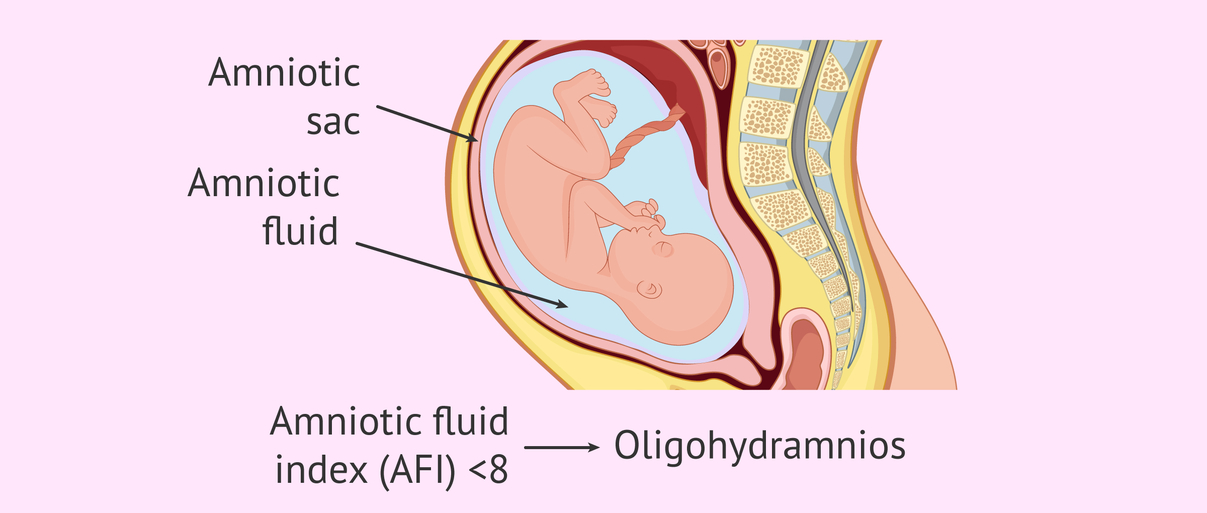 Polyhydramnios - Symptoms and causes - Mayo Clinic