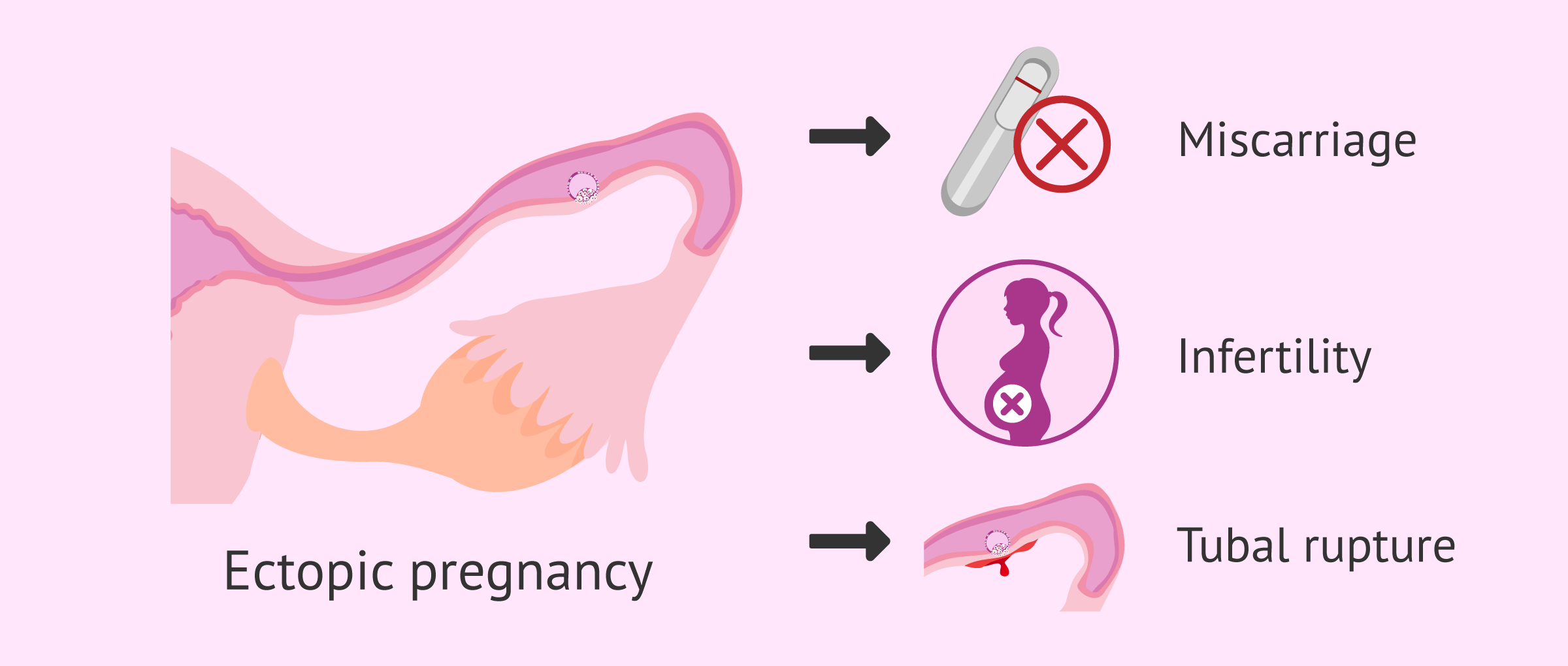 Consequences of ectopic pregnancy
