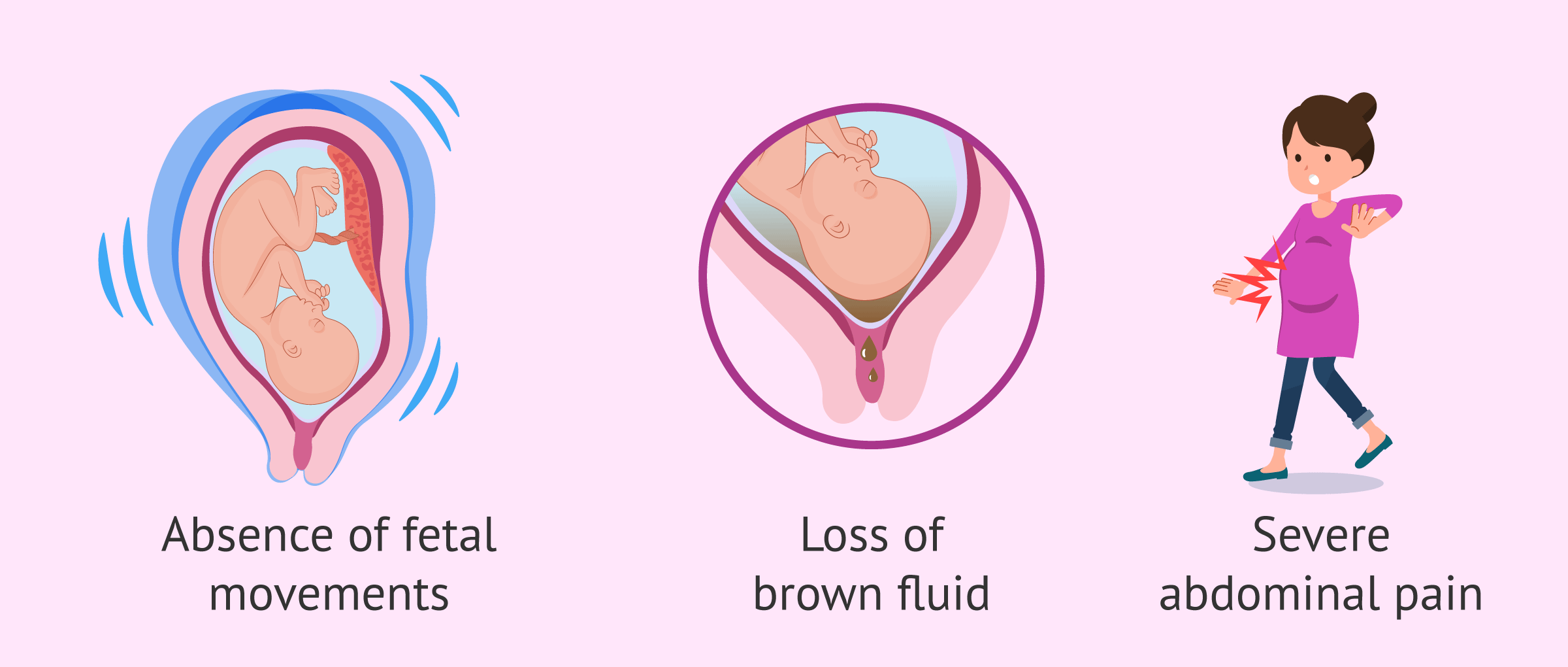Symptoms of intrauterine fetal death