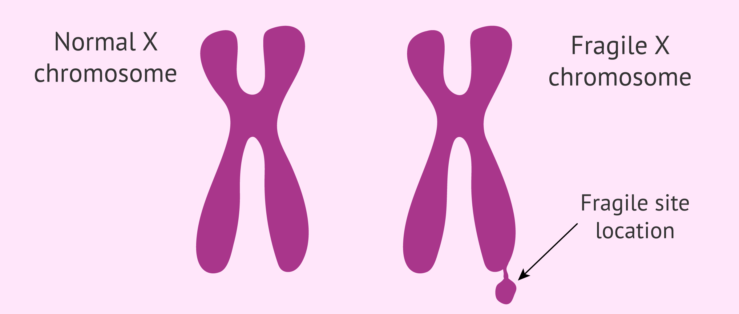 Comparison between normal chromosome and fragile X chromosome