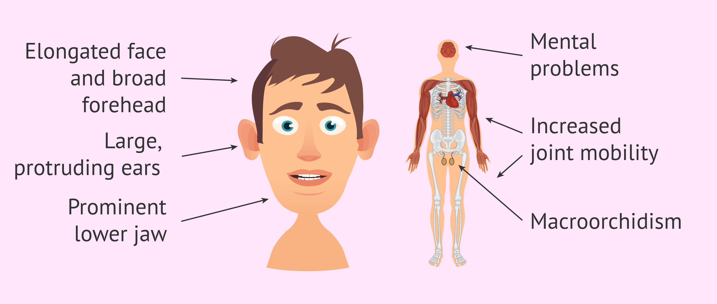 Fragile X Syndrome What It Is Causes Symptoms And Treatment