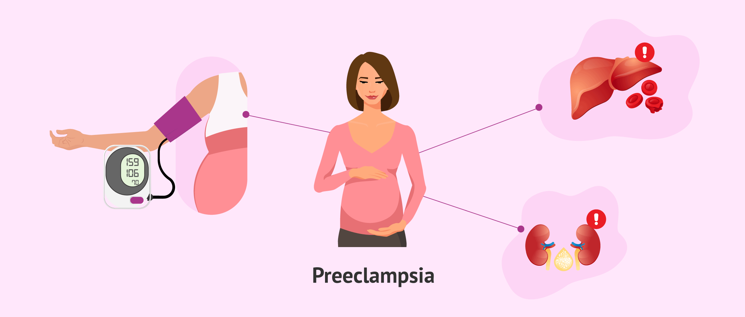 What is preeclampsia in pregnancy and why does it occur?