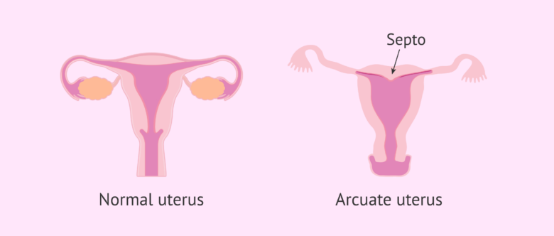 Arcuate uterus, uterine anomaly