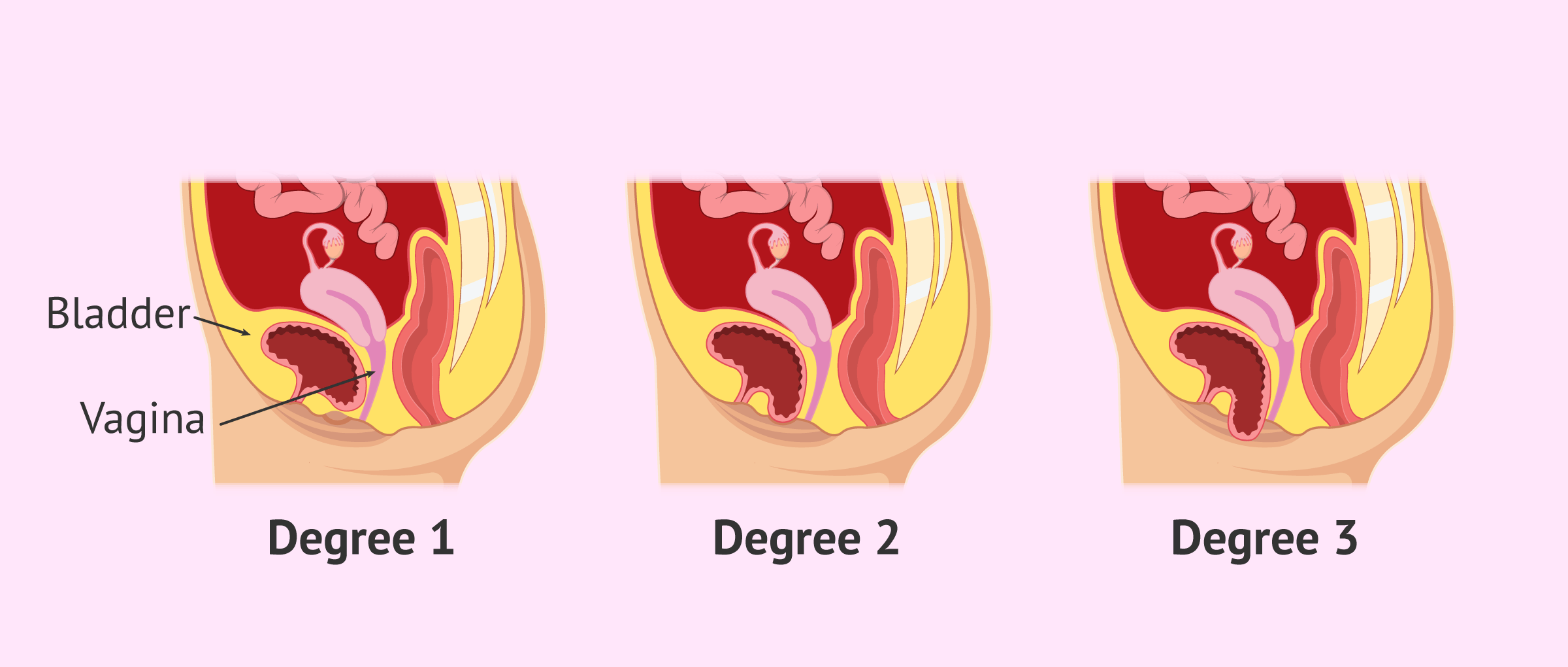 Design Veronique Scrotum Support Brief #1045 - Nightingale Medical