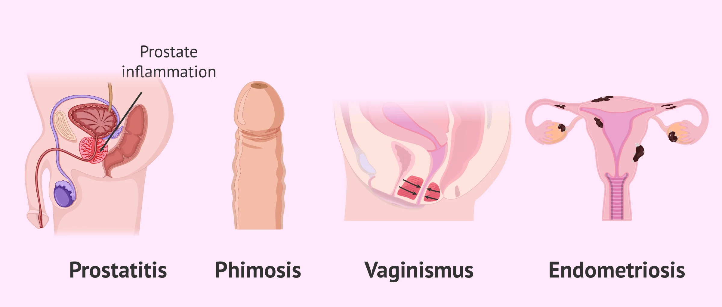 Imagen: dyspareunia-pain-sexual-intercourse