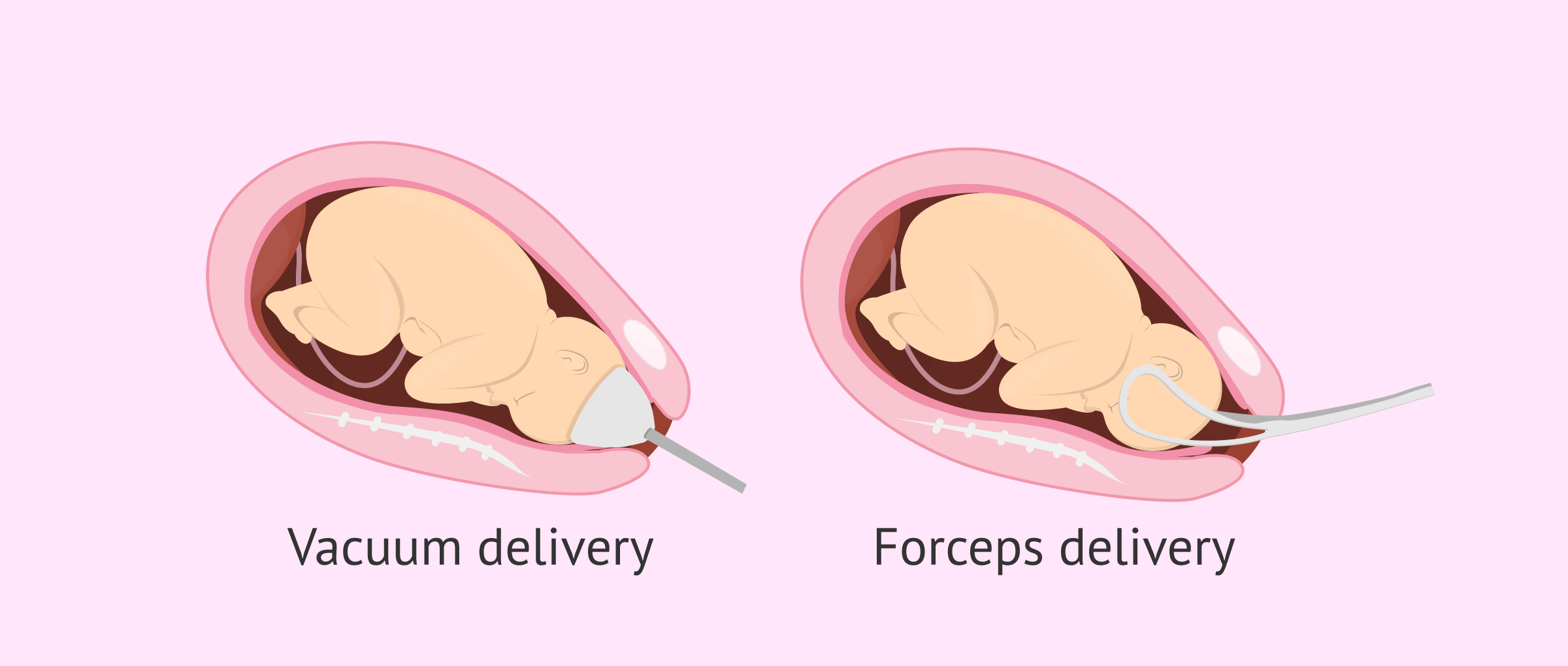 assisted-delivery-vacuum-forceps