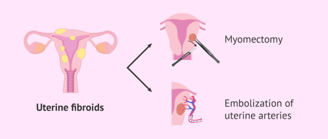 Image result for hysterectomy genetic testing for women - Hysterectomy Genetic Testing For Women