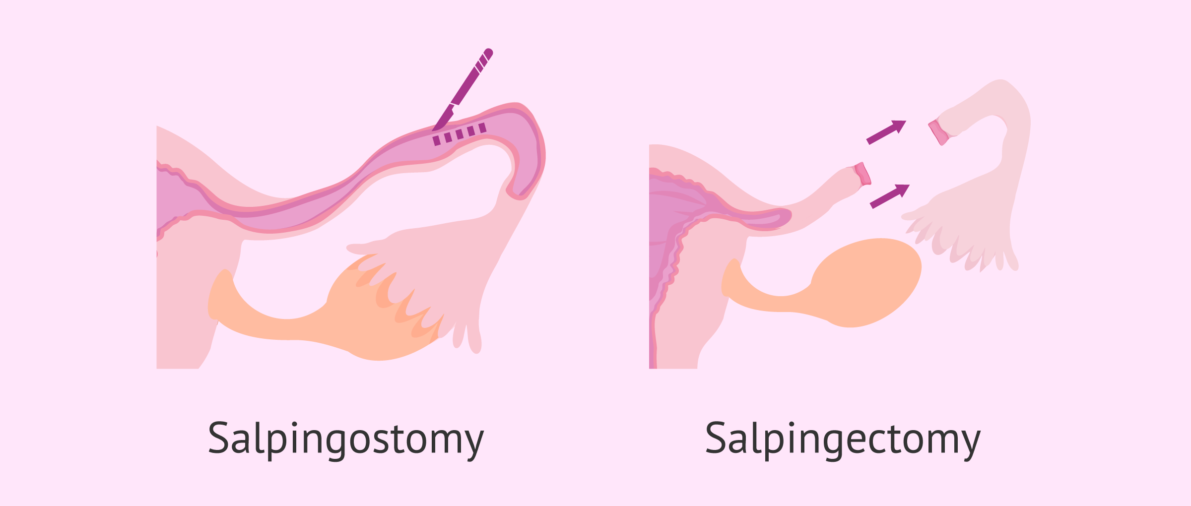 Salpingostomy and salpingectomy for treatment of ectopic pregnancy