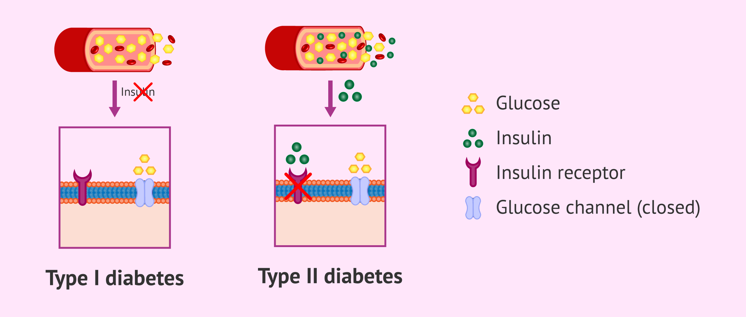 Imagen: What types of diabetes exist?