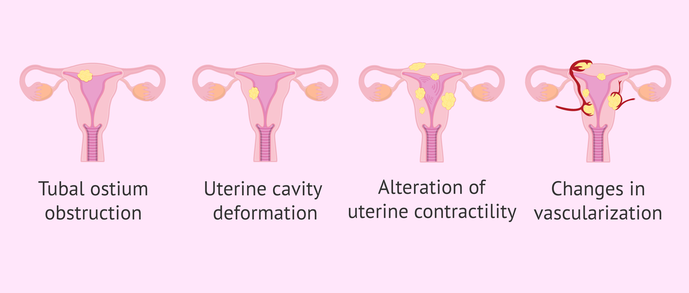 How can uterine fibroids affect fertility?