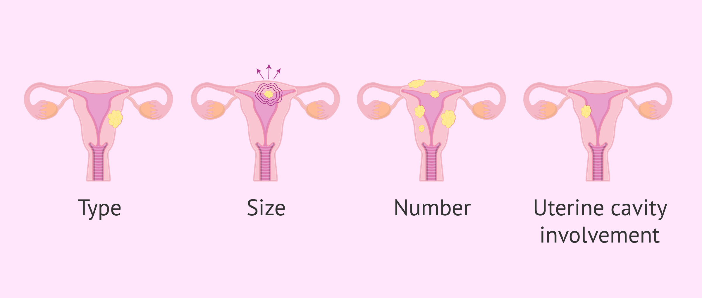 Do uterine fibroids affect IVF?