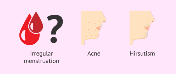 Imagen: Irregular menstruation and PCOS