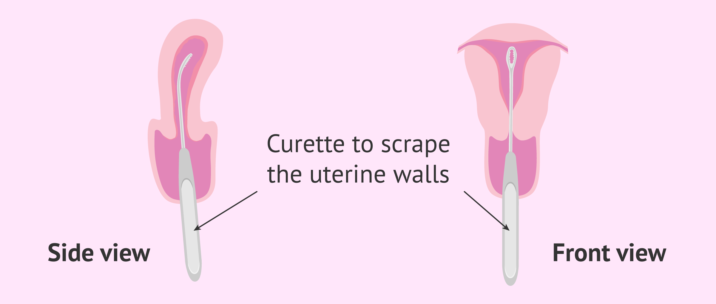 Curettage of the uterine walls